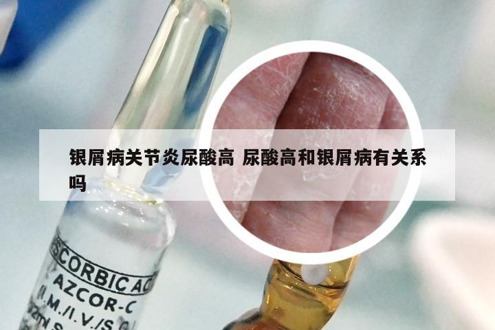 银屑病关节炎尿酸高 尿酸高和银屑病有关系吗