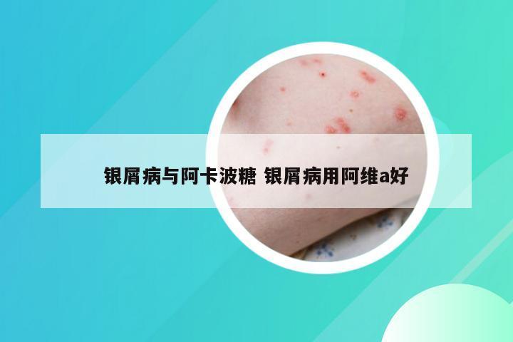 银屑病与阿卡波糖 银屑病用阿维a好