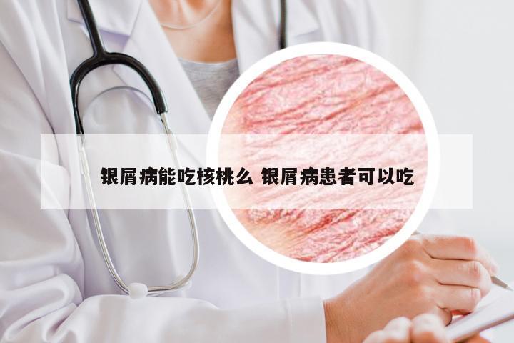 银屑病能吃核桃么 银屑病患者可以吃