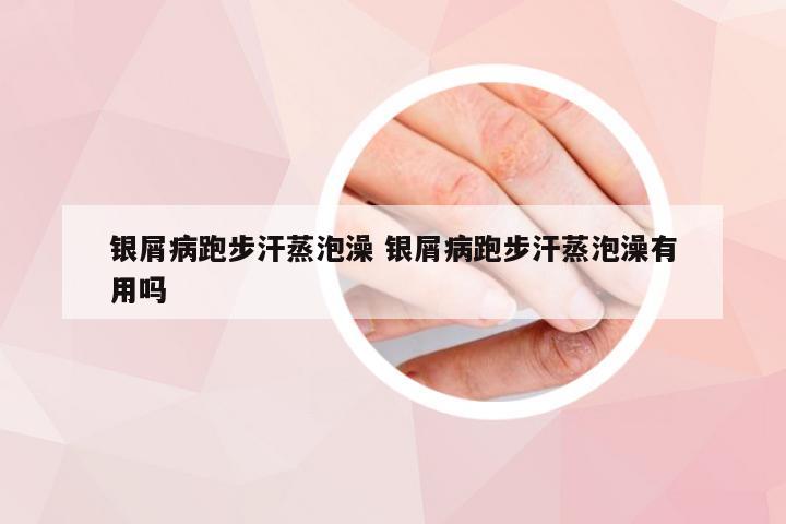 银屑病跑步汗蒸泡澡 银屑病跑步汗蒸泡澡有用吗