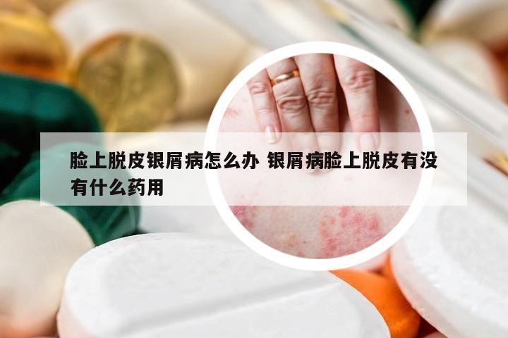 脸上脱皮银屑病怎么办 银屑病脸上脱皮有没有什么药用