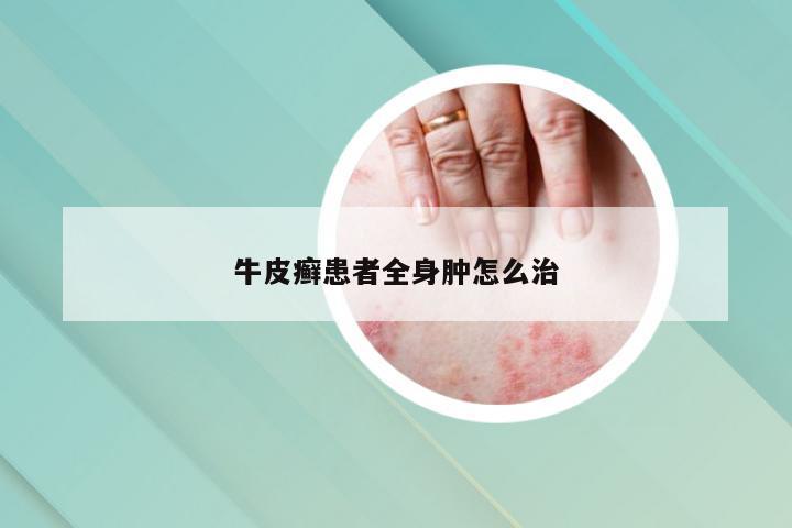 牛皮癣患者全身肿怎么治