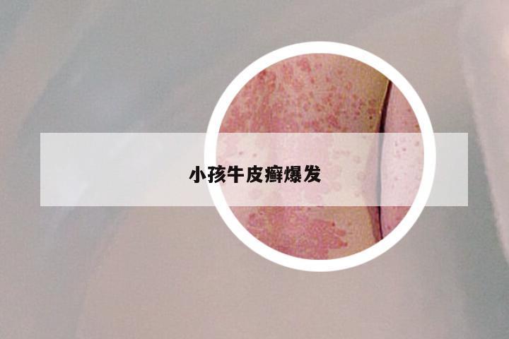 小孩牛皮癣爆发
