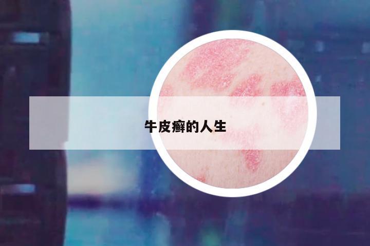 牛皮癣的人生