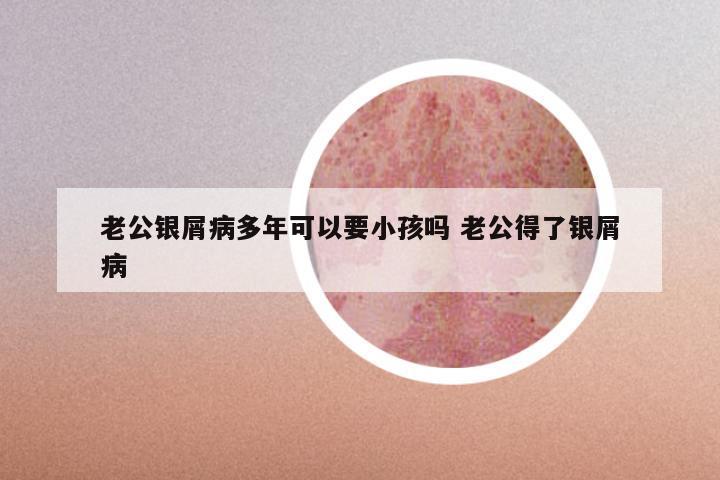 老公银屑病多年可以要小孩吗 老公得了银屑病