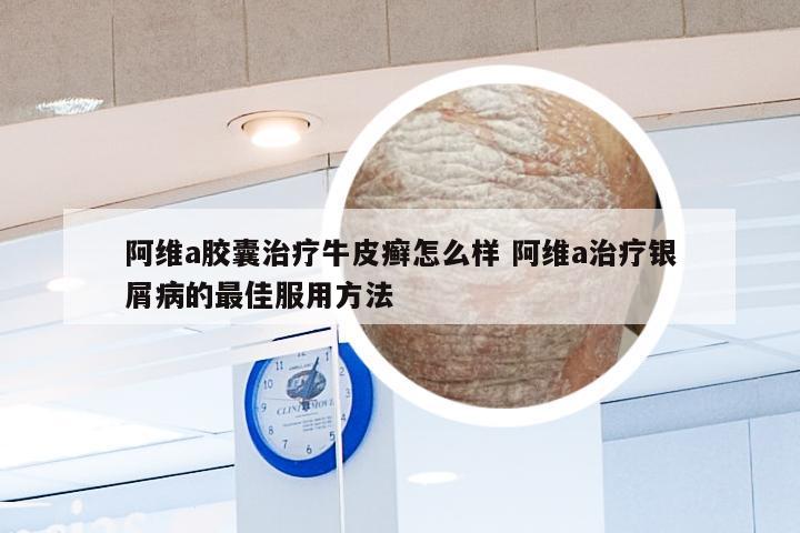 阿维a胶囊治疗牛皮癣怎么样 阿维a治疗银屑病的最佳服用方法