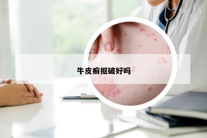 牛皮癣抠破好吗