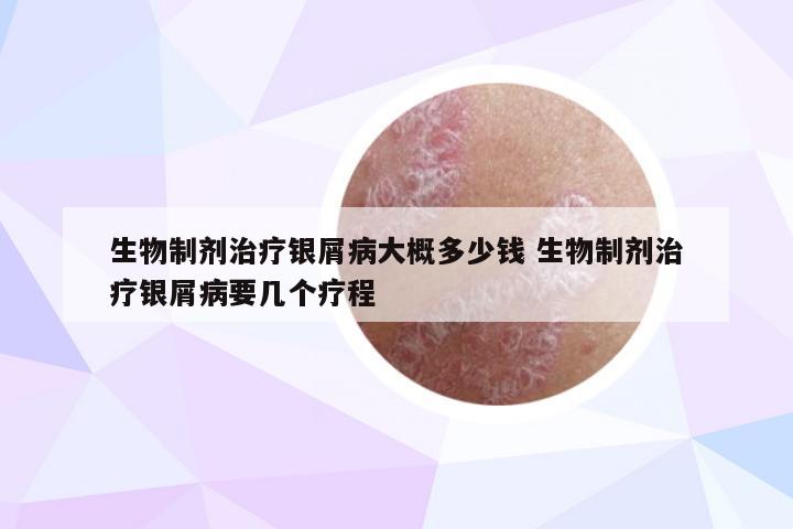 生物制剂治疗银屑病大概多少钱 生物制剂治疗银屑病要几个疗程