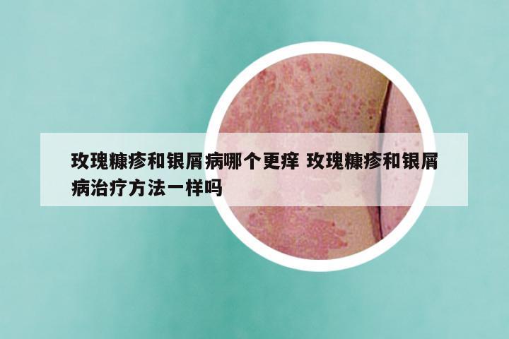玫瑰糠疹和银屑病哪个更痒 玫瑰糠疹和银屑病治疗方法一样吗