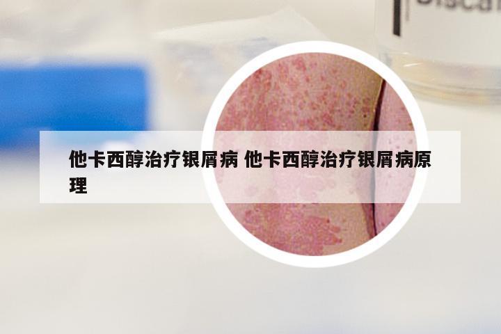 他卡西醇治疗银屑病 他卡西醇治疗银屑病原理