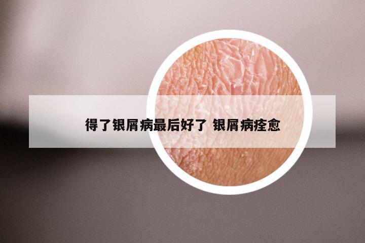 得了银屑病最后好了 银屑病痊愈