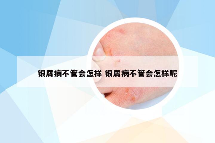 银屑病不管会怎样 银屑病不管会怎样呢