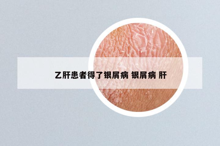 乙肝患者得了银屑病 银屑病 肝