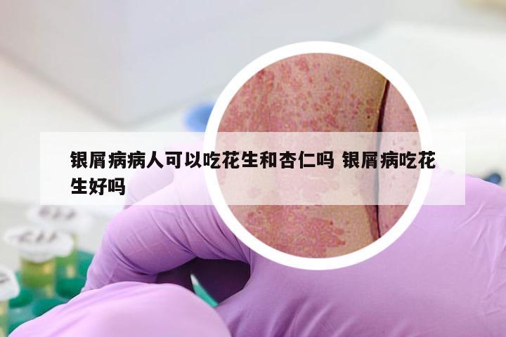 银屑病病人可以吃花生和杏仁吗 银屑病吃花生好吗
