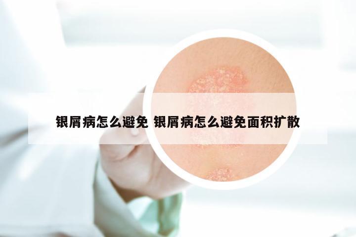银屑病怎么避免 银屑病怎么避免面积扩散