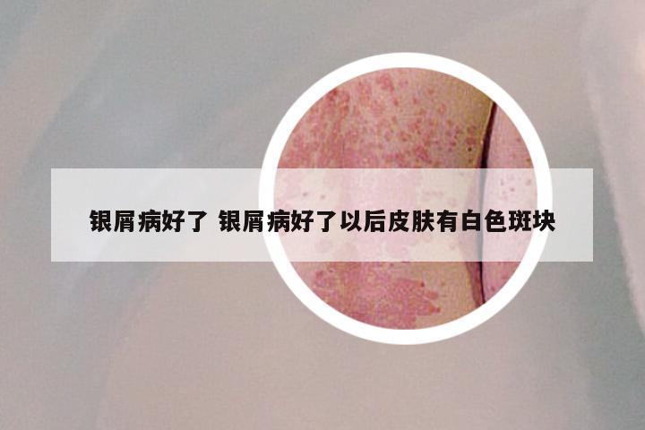 银屑病好了 银屑病好了以后皮肤有白色斑块