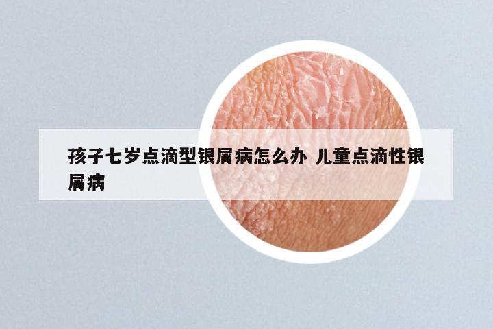 孩子七岁点滴型银屑病怎么办 儿童点滴性银屑病