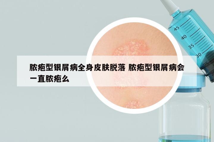 脓疱型银屑病全身皮肤脱落 脓疱型银屑病会一直脓疱么