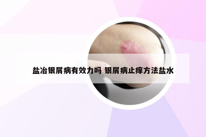 盐冶银屑病有效力吗 银屑病止痒方法盐水