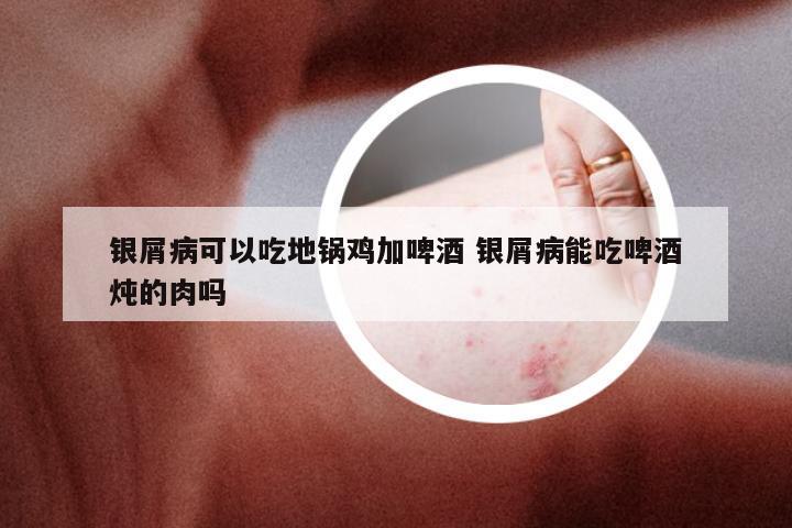 银屑病可以吃地锅鸡加啤酒 银屑病能吃啤酒炖的肉吗