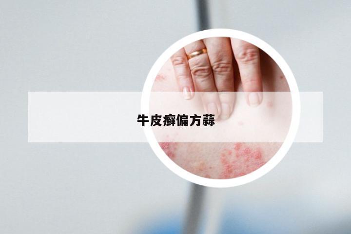 牛皮癣偏方蒜