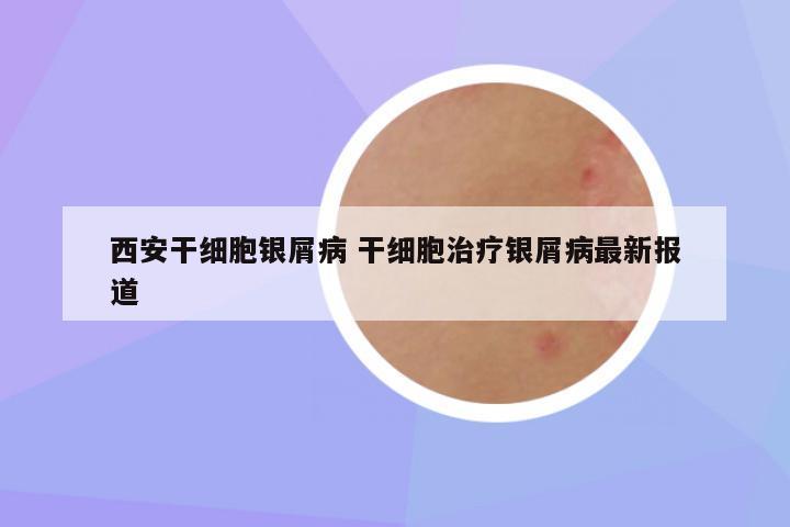 西安干细胞银屑病 干细胞治疗银屑病最新报道