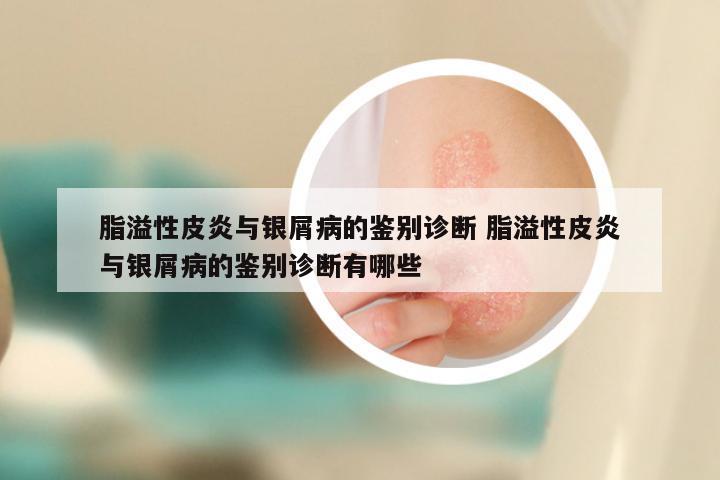 脂溢性皮炎与银屑病的鉴别诊断 脂溢性皮炎与银屑病的鉴别诊断有哪些