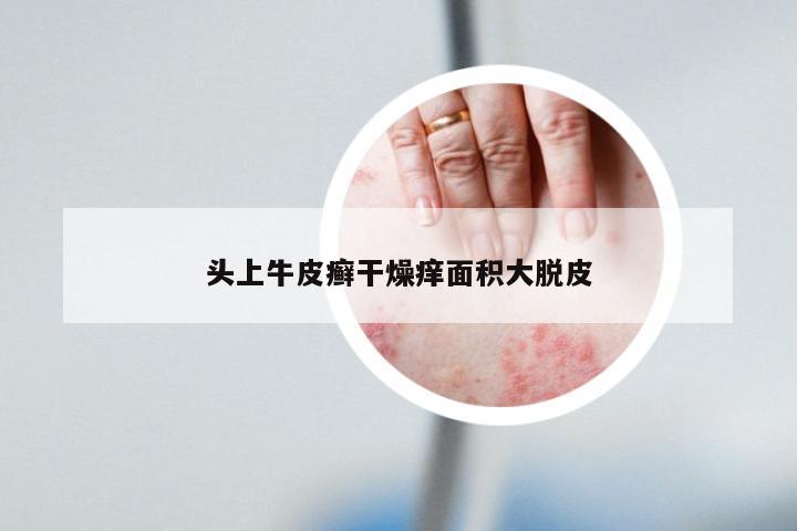 头上牛皮癣干燥痒面积大脱皮