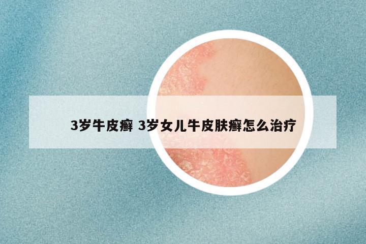 3岁牛皮癣 3岁女儿牛皮肤癣怎么治疗