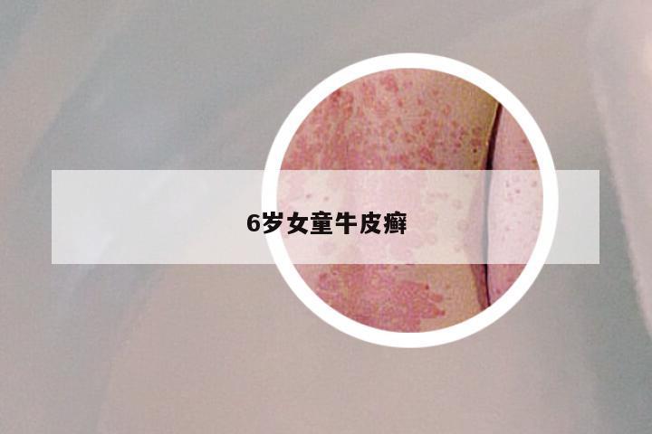 6岁女童牛皮癣