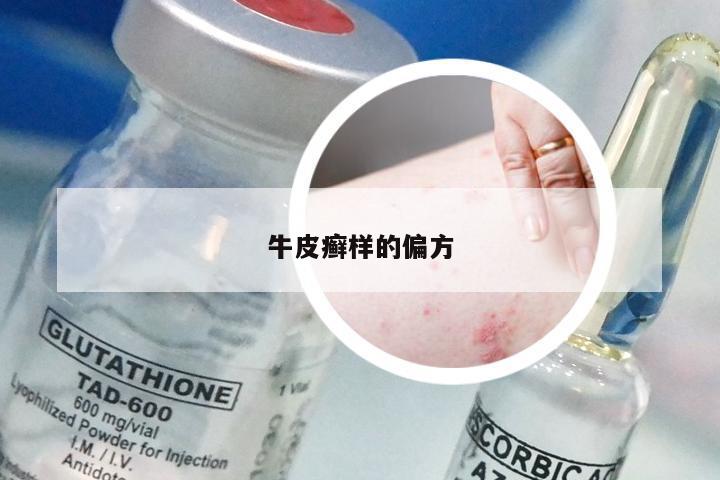 牛皮癣样的偏方