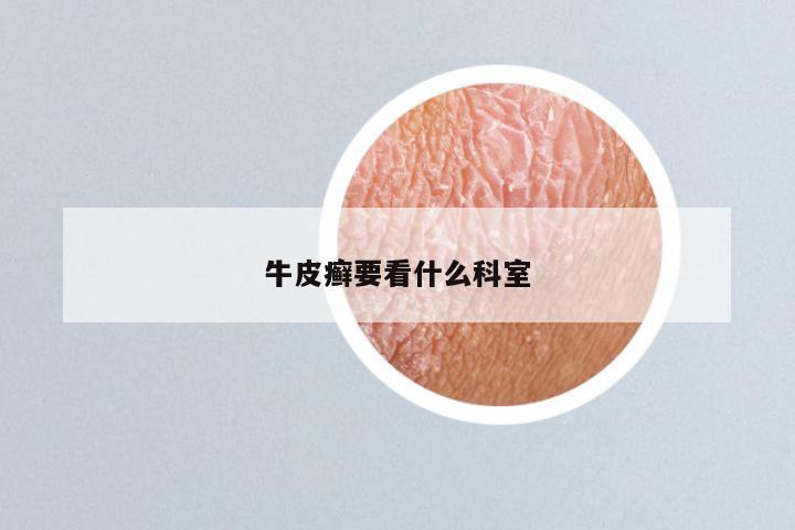 牛皮癣要看什么科室