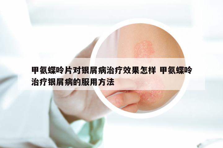 甲氨蝶呤片对银屑病治疗效果怎样 甲氨蝶呤治疗银屑病的服用方法