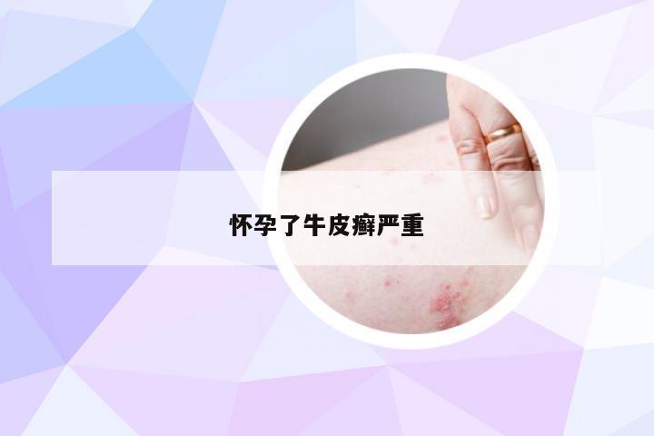 怀孕了牛皮癣严重