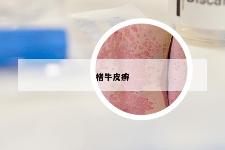 楮牛皮癣