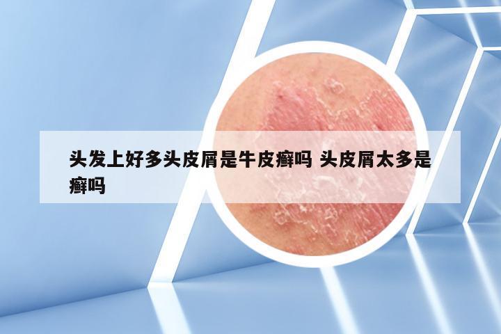 头发上好多头皮屑是牛皮癣吗 头皮屑太多是癣吗