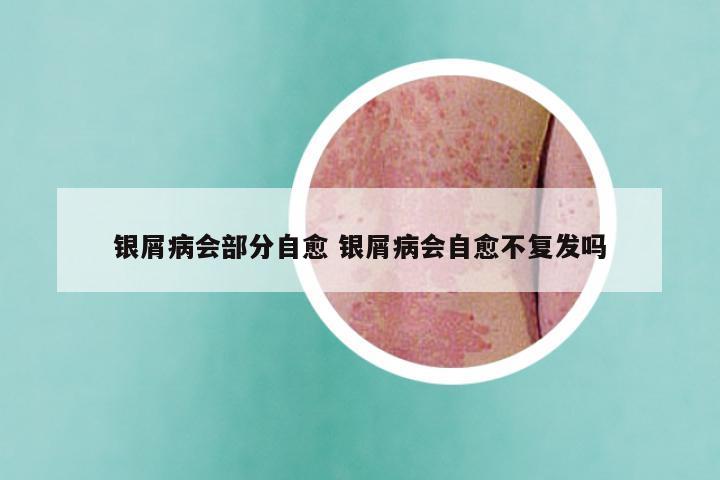 银屑病会部分自愈 银屑病会自愈不复发吗