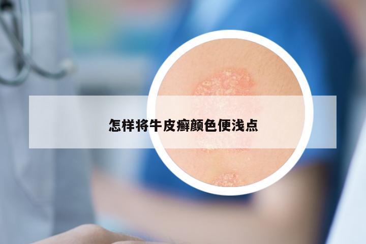 怎样将牛皮癣颜色便浅点