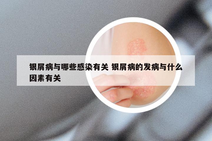 银屑病与哪些感染有关 银屑病的发病与什么因素有关