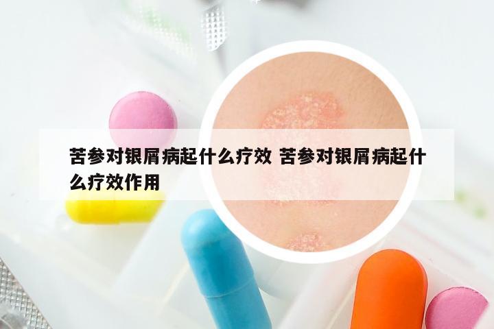 苦参对银屑病起什么疗效 苦参对银屑病起什么疗效作用