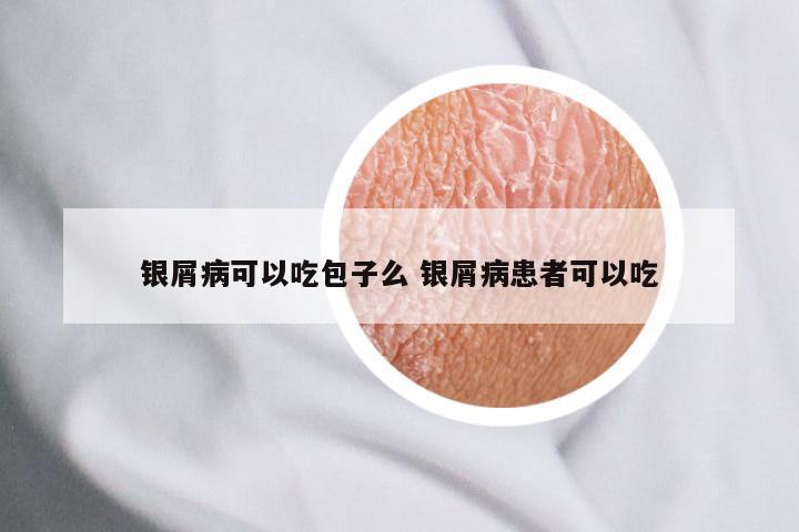 银屑病可以吃包子么 银屑病患者可以吃
