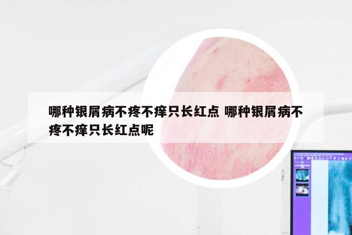 哪种银屑病不疼不痒只长红点 哪种银屑病不疼不痒只长红点呢