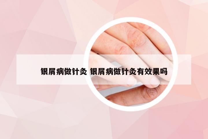 银屑病做针灸 银屑病做针灸有效果吗