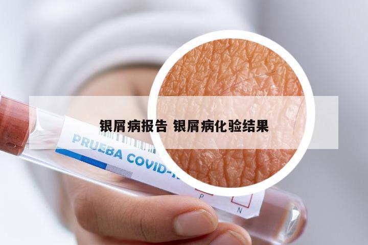 银屑病报告 银屑病化验结果