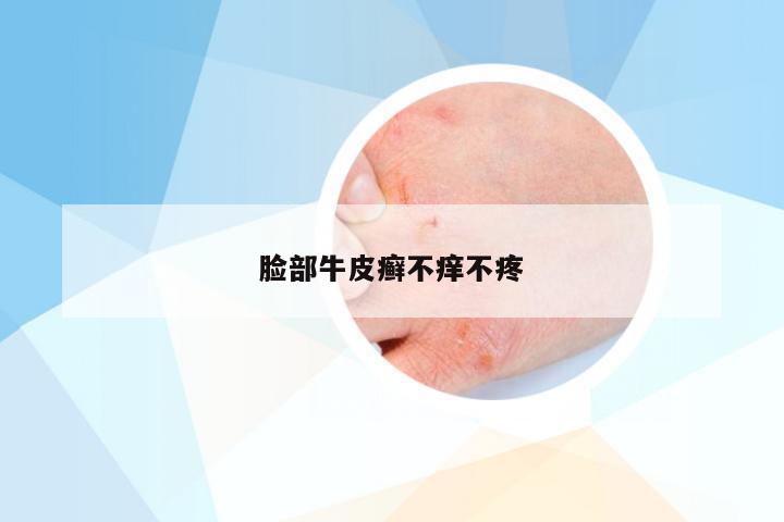 脸部牛皮癣不痒不疼