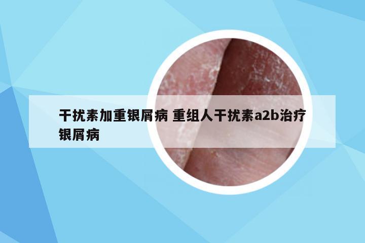 干扰素加重银屑病 重组人干扰素a2b治疗银屑病