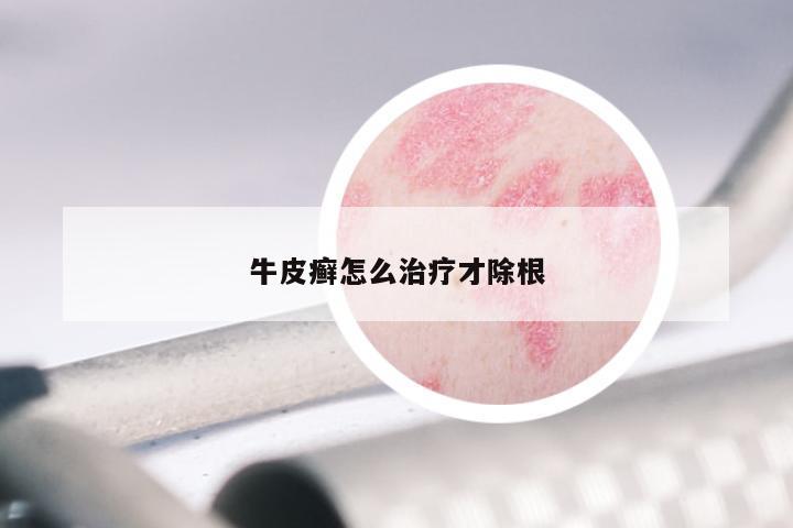 牛皮癣怎么治疗才除根