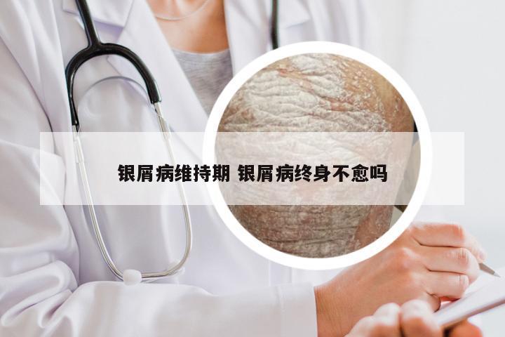 银屑病维持期 银屑病终身不愈吗