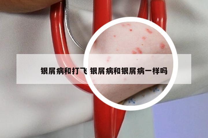 银屑病和打飞 银屑病和银屑病一样吗
