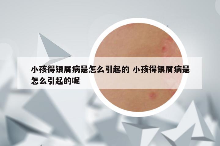小孩得银屑病是怎么引起的 小孩得银屑病是怎么引起的呢